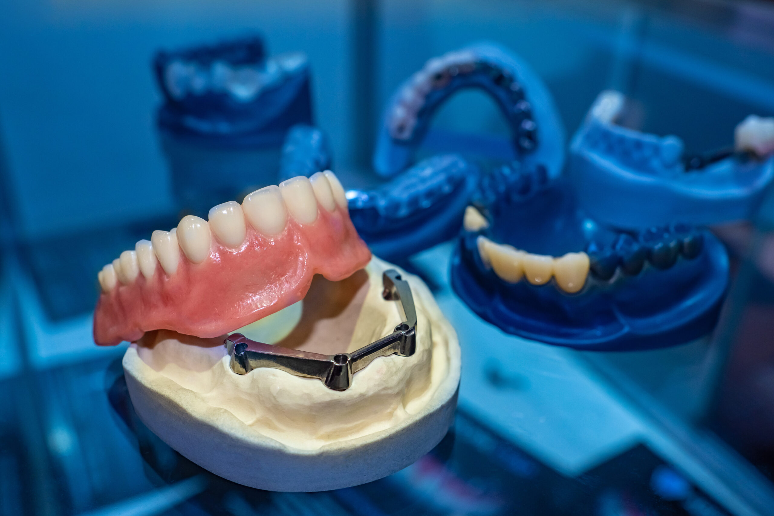 What Is The Difference Between Removable Dentures And Implant Supported Dentures In Fort Lauderdale, FL?