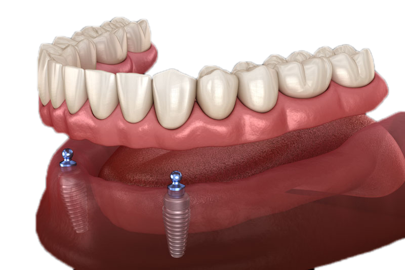 Full Mouth Dental Implants Pembroke Pines, FL Smile Design Dental