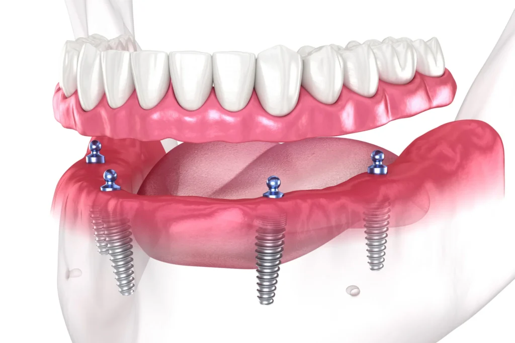 gums with posts from implants